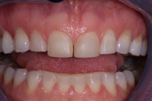 before image