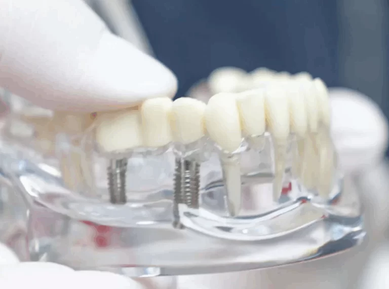 Illustration of dental implants