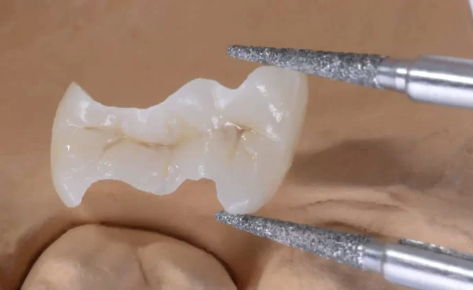ceramic inlays used for tooth restoration